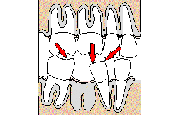 осле удаления зуба, соседние с ним зубы начинают постепенно смещаться